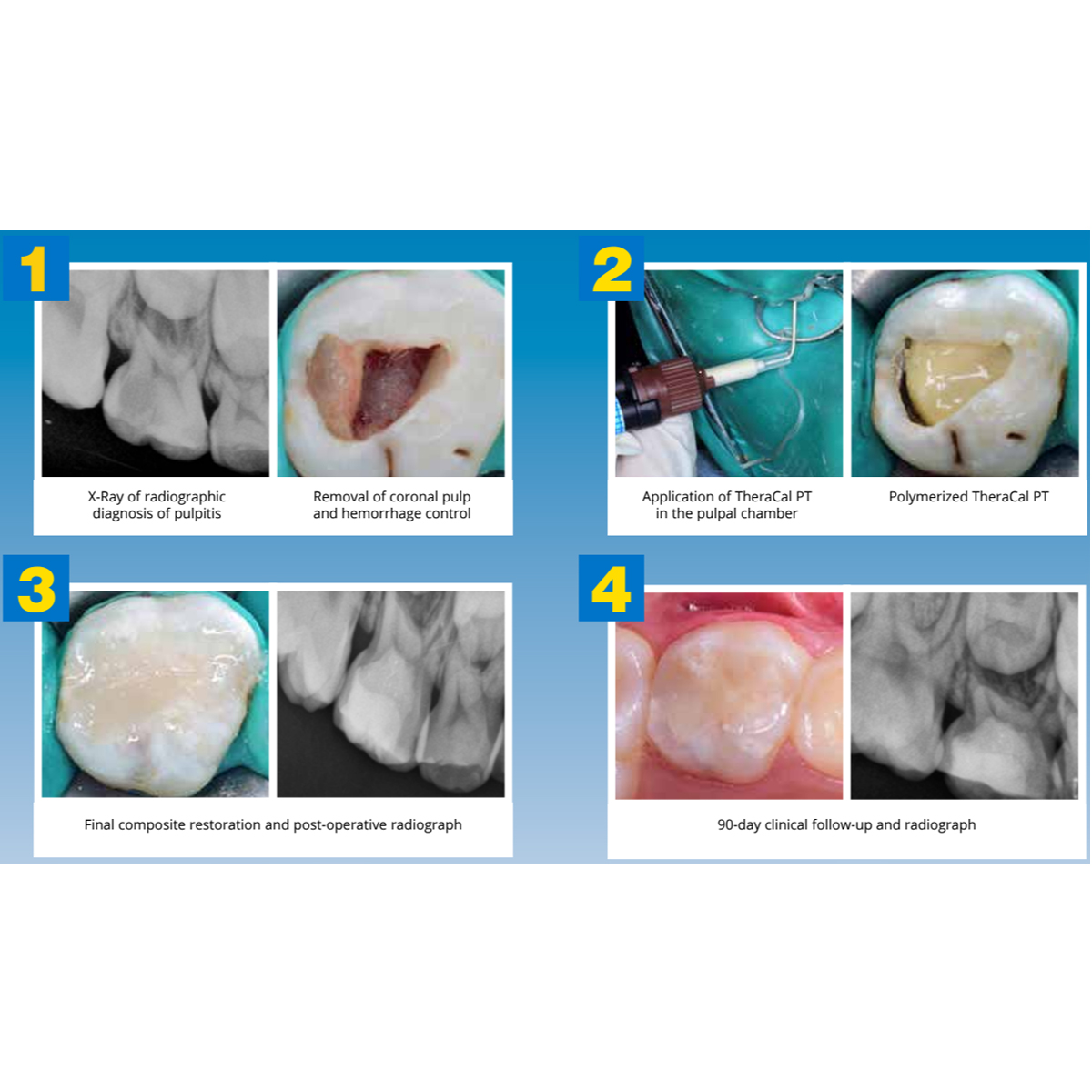 Bisco H-3301P TheraCal LC – Light-Cured Resin-Modified Calcium Silicate – 1 Syringe – Dental Use