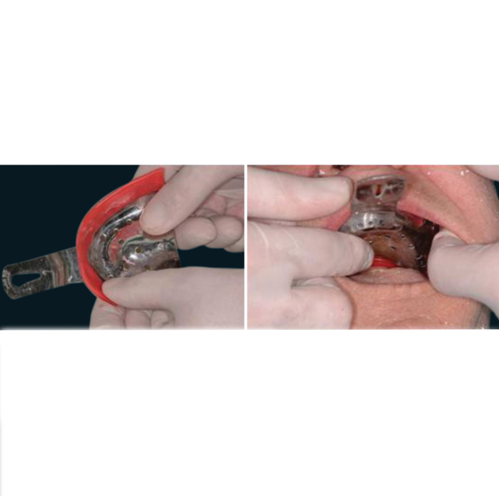 Gdc Impression Trays Edentulous Perforated