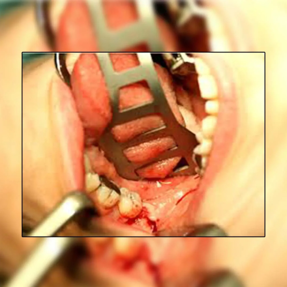 Oracraft Bruenings Retractor (TRB)