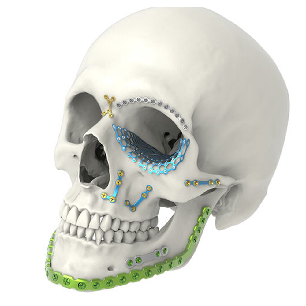 SK Surgicals Titanium Reconstruction Plates U Shape - 2.5mm (32 Holes) 205.932T