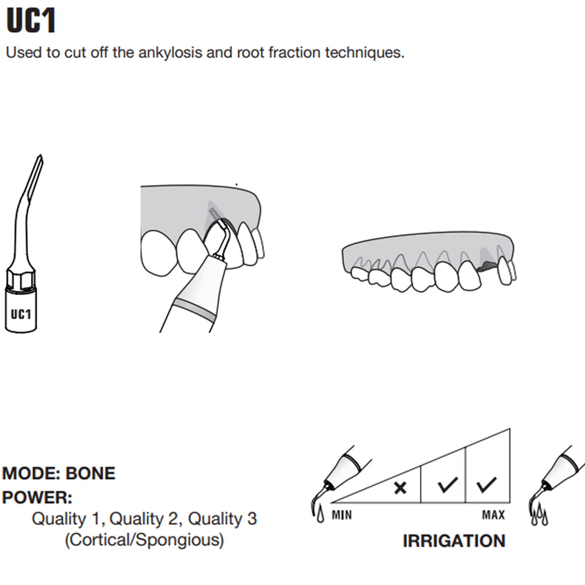 Woodpecker Piezo Bone Surgery Tips