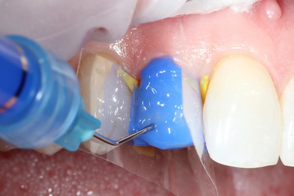 SafeEndo Smart Etch 5ml