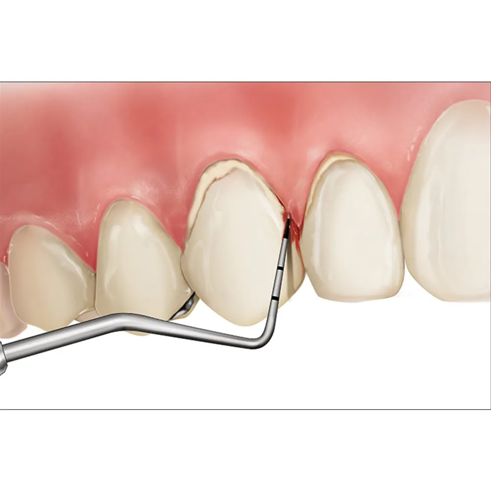 Waldent UNC 15 Probes
