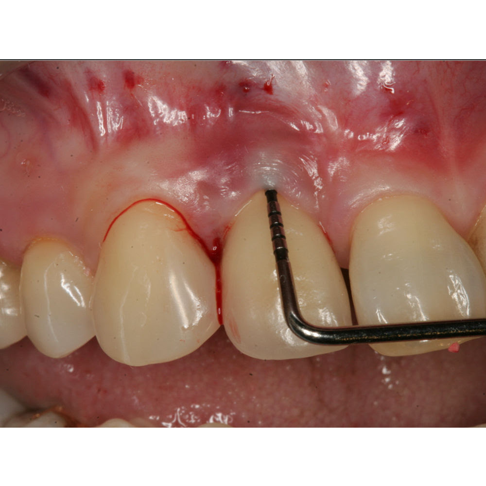 Oracraft Periodontal Probes