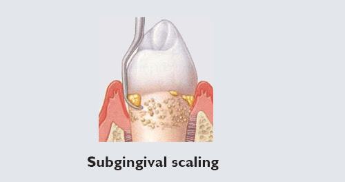 Api+ Curette MC Call Hollow Handle