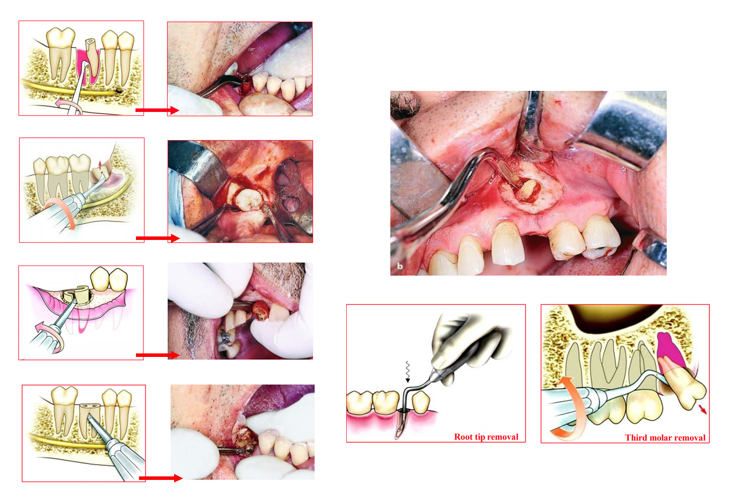 Waldent Root Elevators Premium Set of 11 (K2/2)