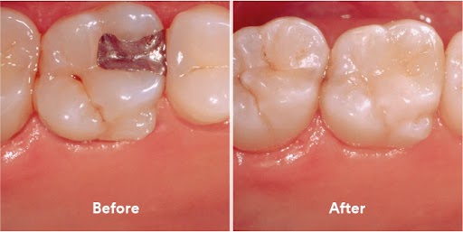 3M ESPE Filtek Z250 Xt Restorative Syringe