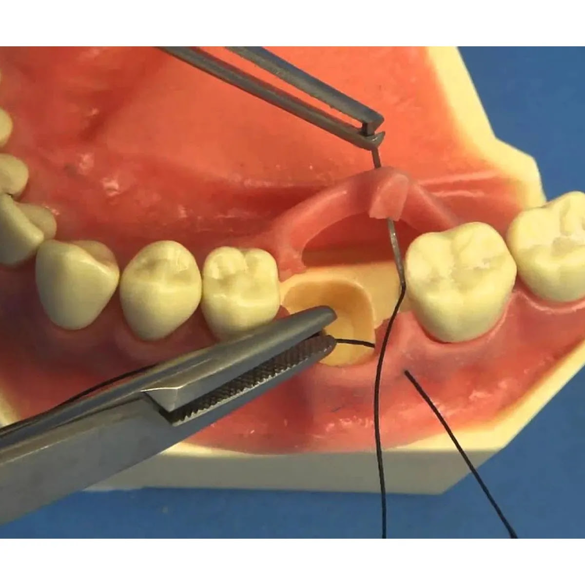 Meril Mericron XL #4-0 Polyester Suture