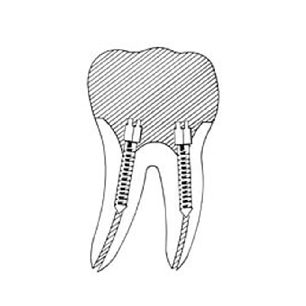 EndoKing Dental Conical Screw Posts 