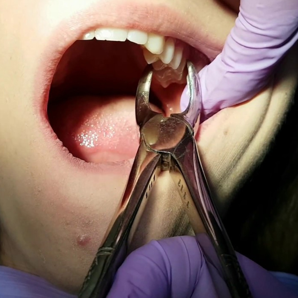 Waldent Extraction Forceps Kit Set of 12 (K1/1)     