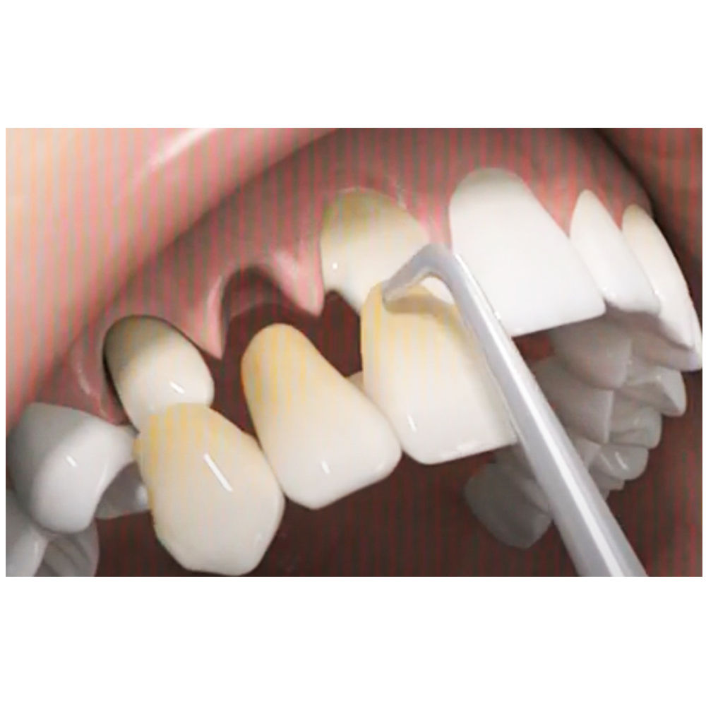 GII Crown Remover Gun Type