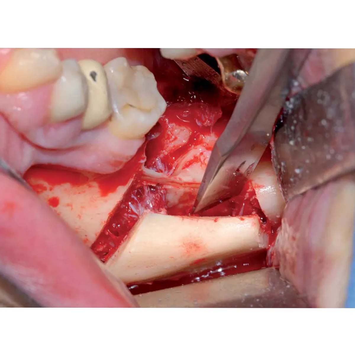 Api+ Bone Chisel Straight