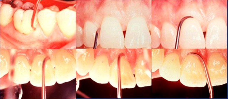 Waldent Gracey Curettes Set of 7 