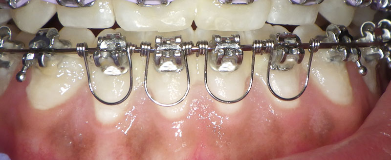 UU Ortho Torque Springs 10 Pcs/Bag