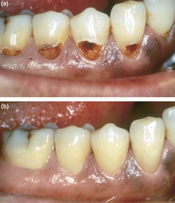 Prevest Crysta Restorative II GIC