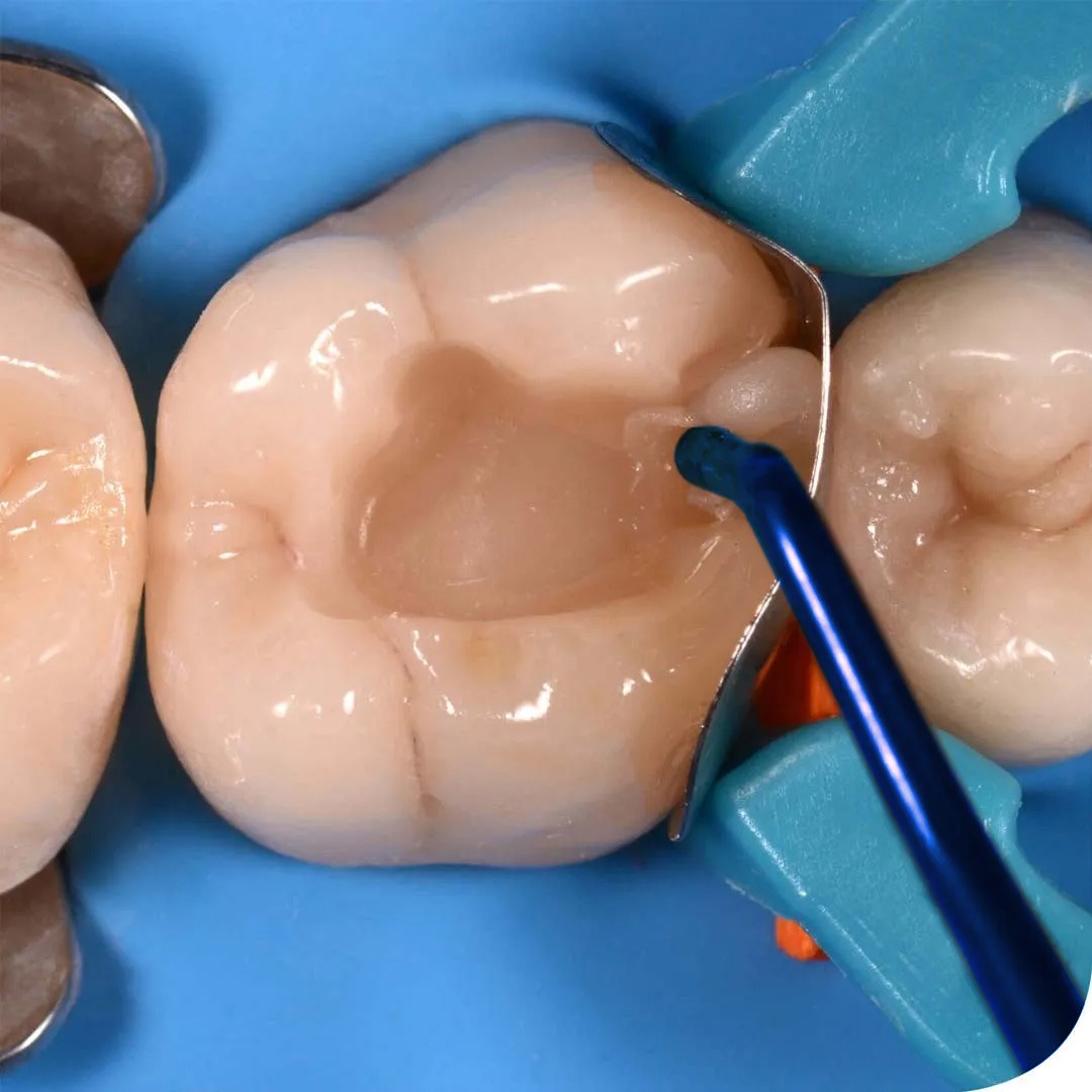 Waldent Plasma+ Composite Instrument Kit of 6 (K14/2)