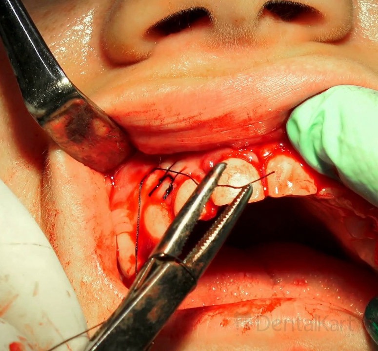 Waldent Oral Surgical Instruments Kit of 10 (K9/1)