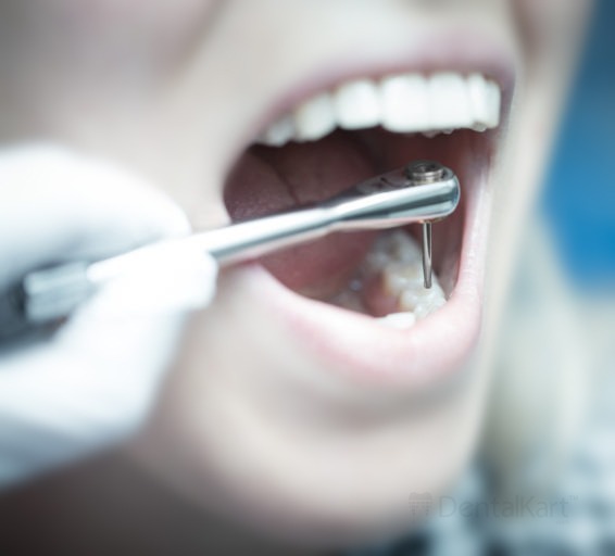 Waldent Implant Ratchet Wrench Dual Sided (19/110)