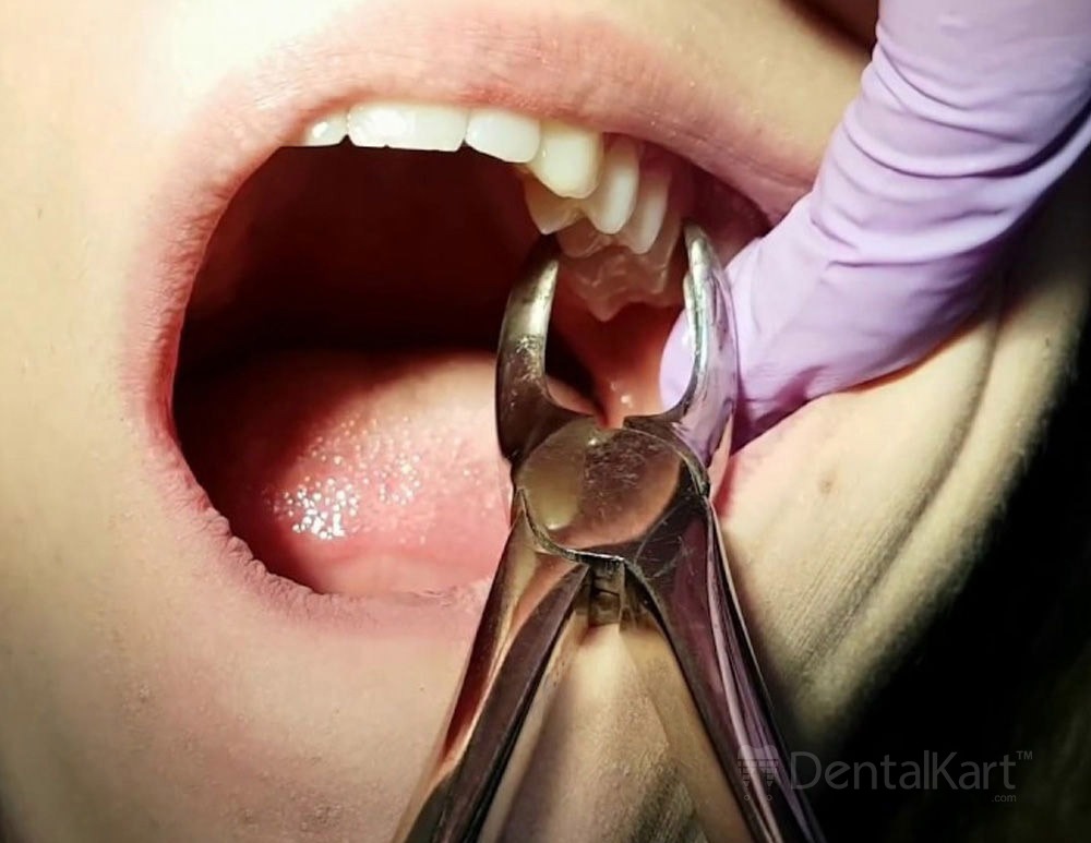 Waldent Tooth Extraction Forceps Upper Molars Left, No.18 (1/105)