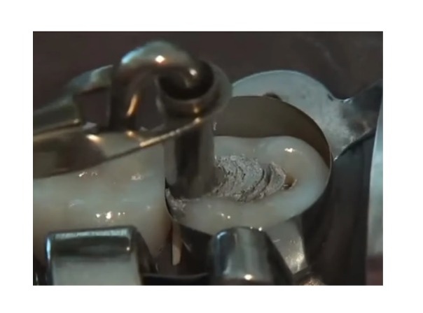 Waldent Amalgam Carrier Double Ended 2.5 x 2.0mm (12/105)