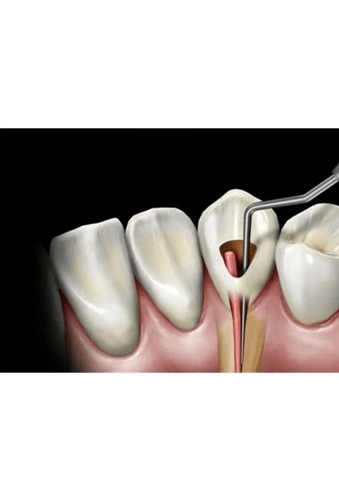 GDC Root Canal Plugger Luks -(.50mm) Rcpl2 #3