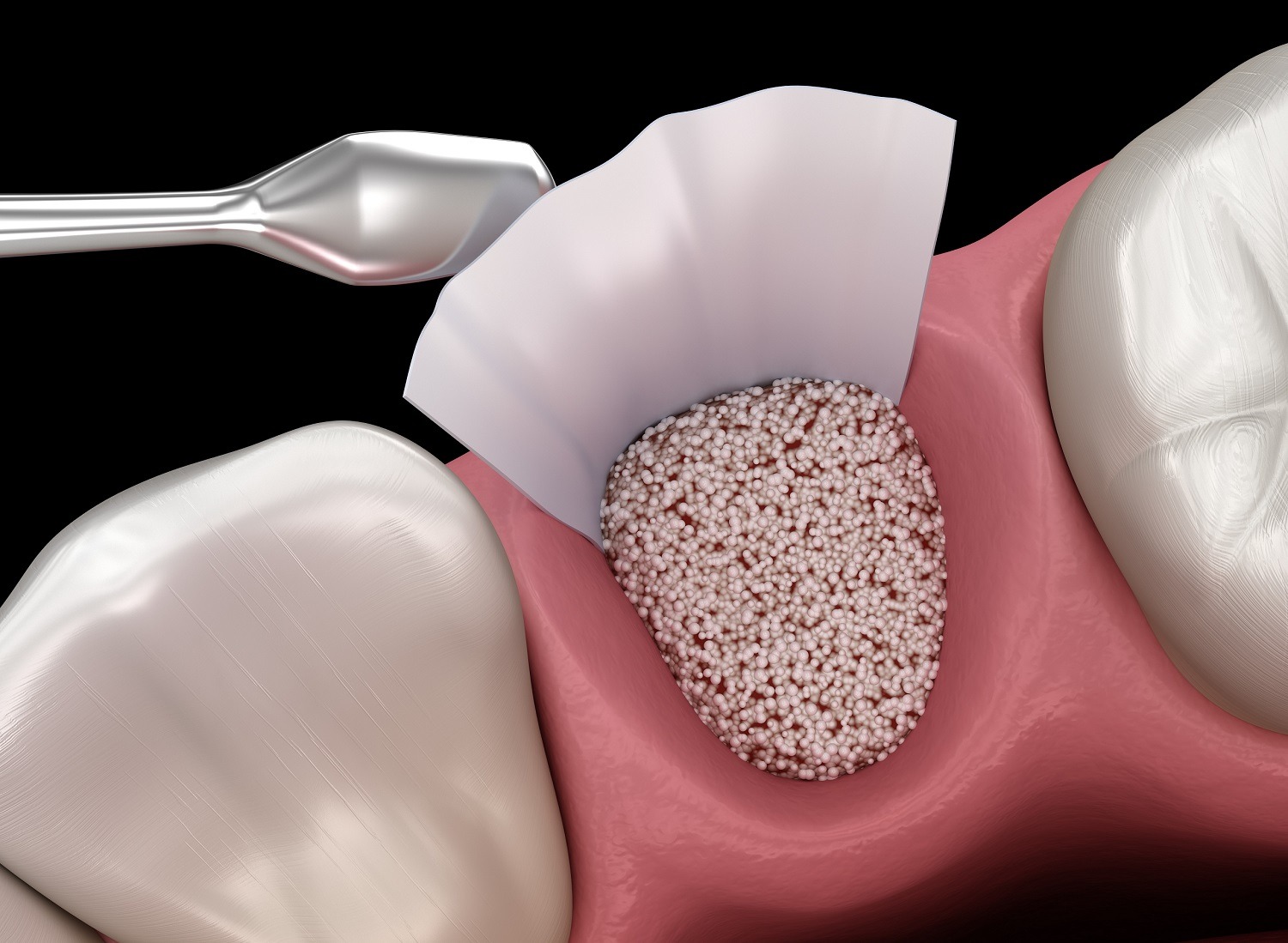 Xcem Osspore Bovine Bone Grafts