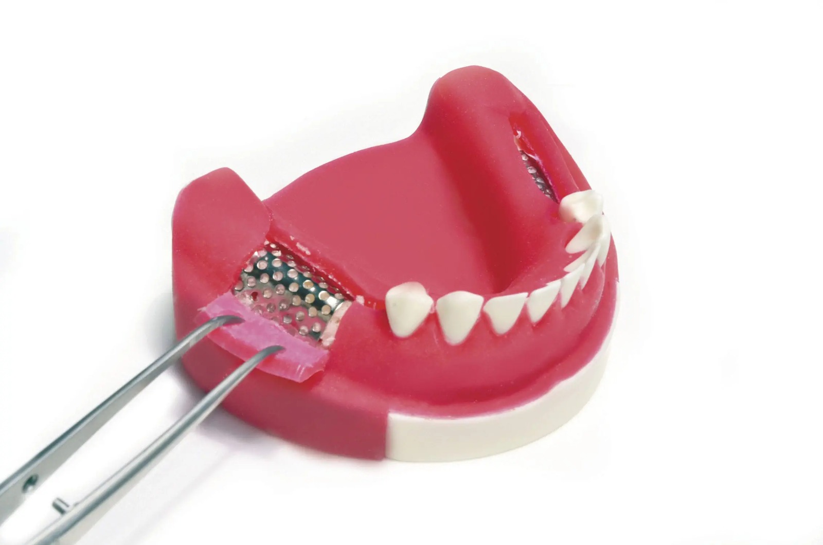 Xcem Osspore Titanium Membranes