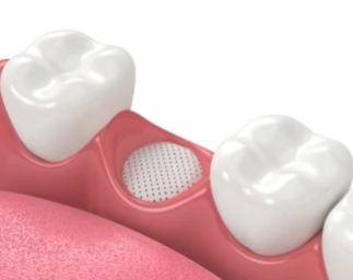 Xcem Osspore PTFE Membranes