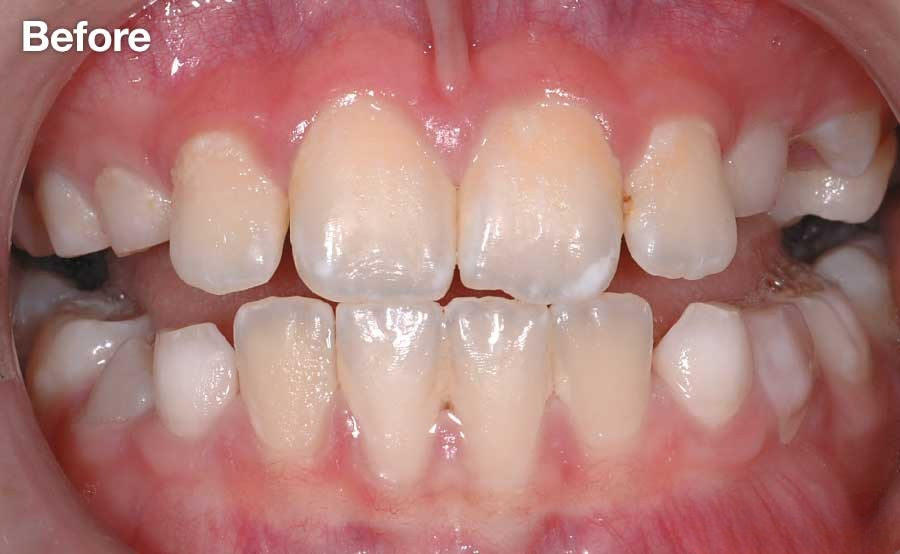 Dr Denti Disclosing Tablets (28 Tablets)