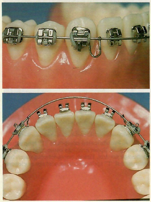 OSL Beta-Titanium Ovoid Form Archwires - Rectangular