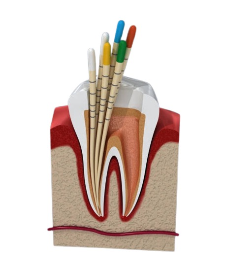 Neoendo Gutta Percha Points 4% (Length Marked)