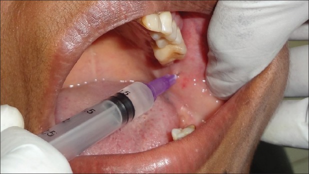 Indoco Warren Lignox Lignocaine 2% (Pack Of 10)