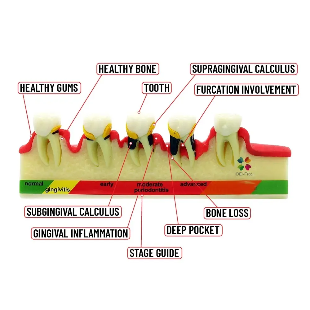 Buy iDENTical Periodontitis Stages Model M4010:High-Quality