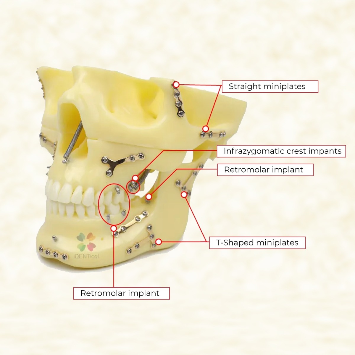 iDENTical Skull Education Model With Fracture And Restoration (M5004)
