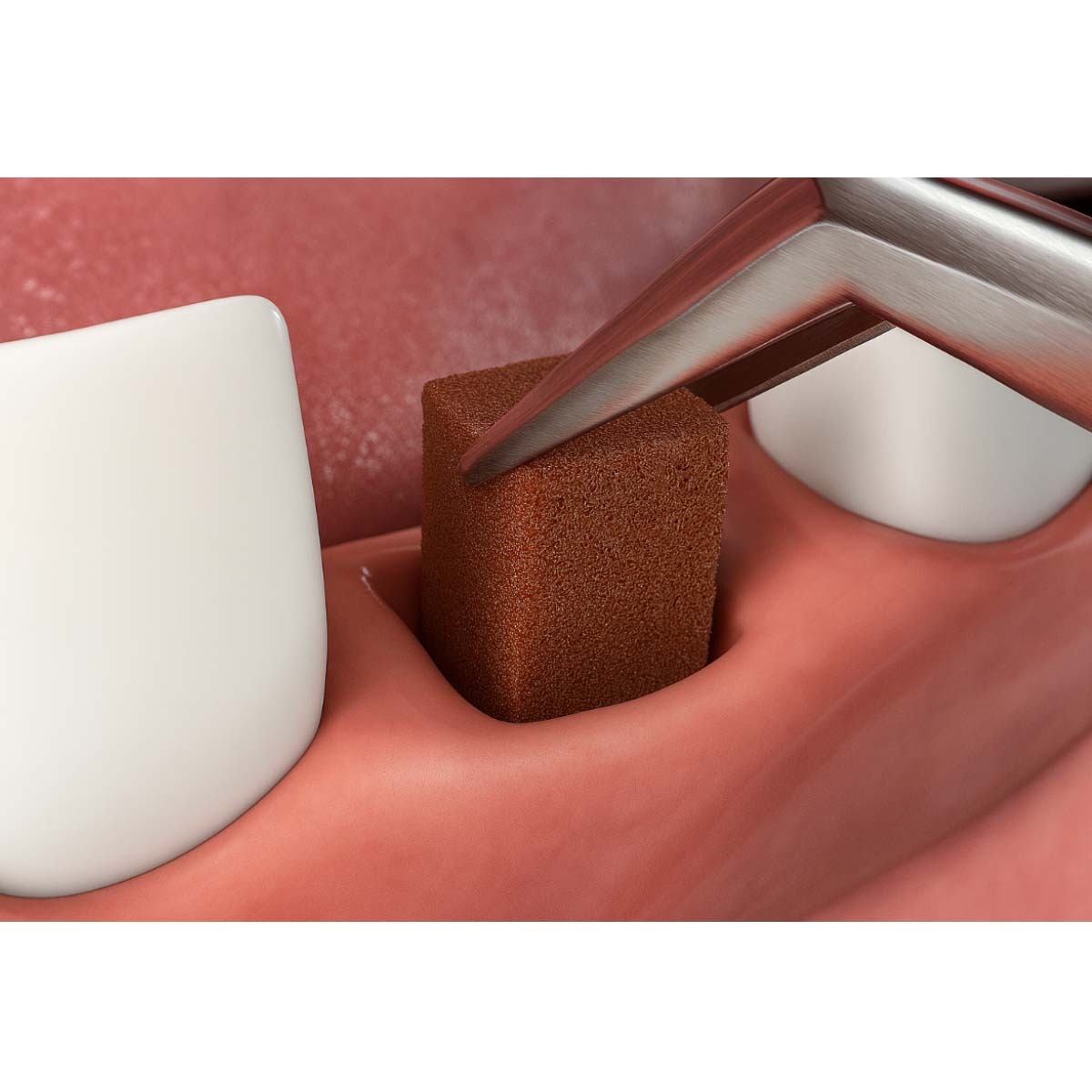 Coltene Gelasponge Absorbable Gelatin Sponge