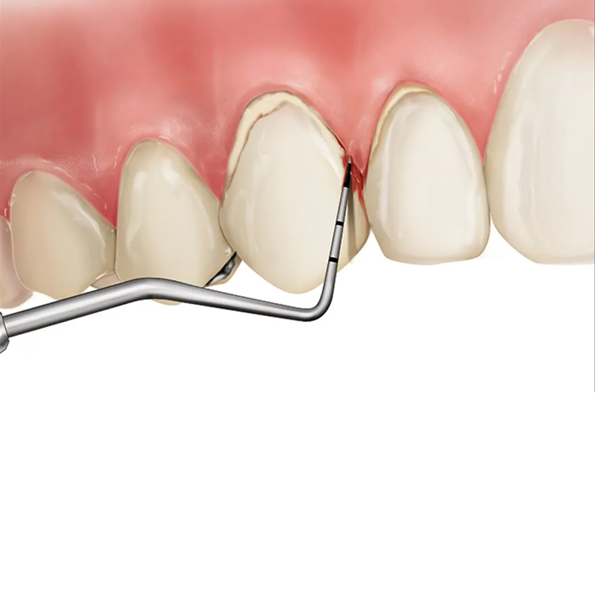 Hahnenkratt WHO Probe Ref 5010