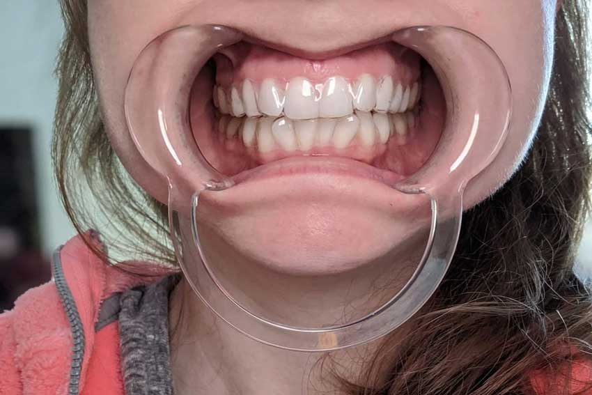 ET Dental Cheek Retractor C Type-Small	