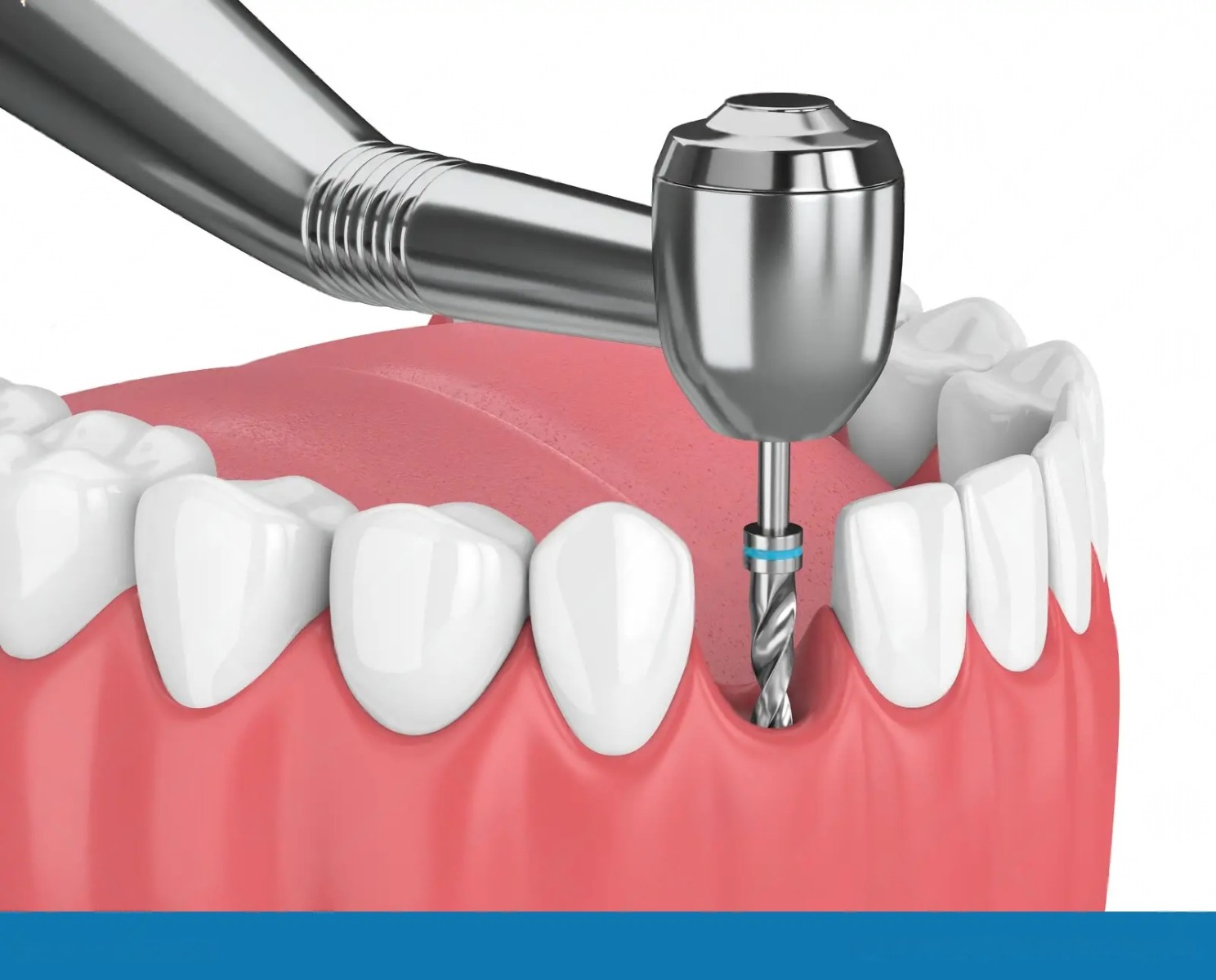 GS Implants Smart Kit