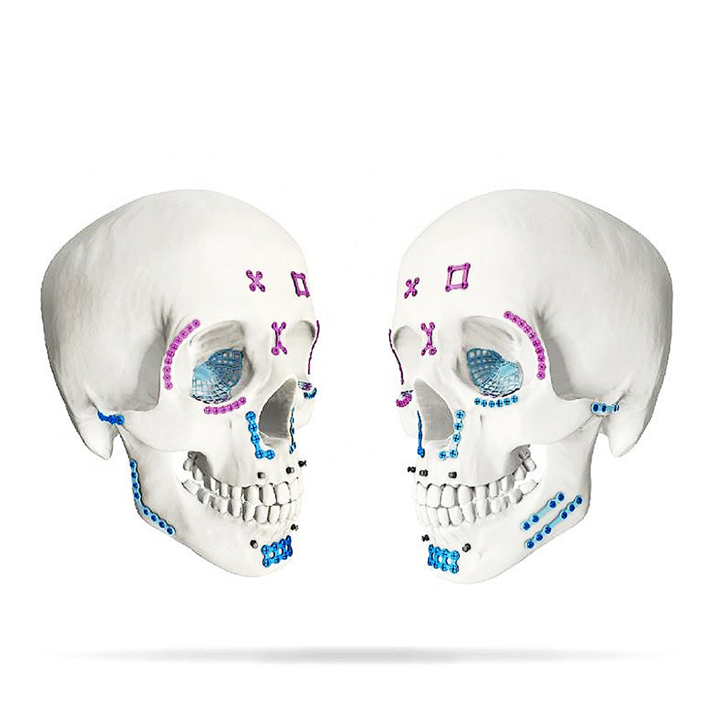 SK Surgicals Titanium Mini Bone Plates X Shape - 1.5mm (105.470T)