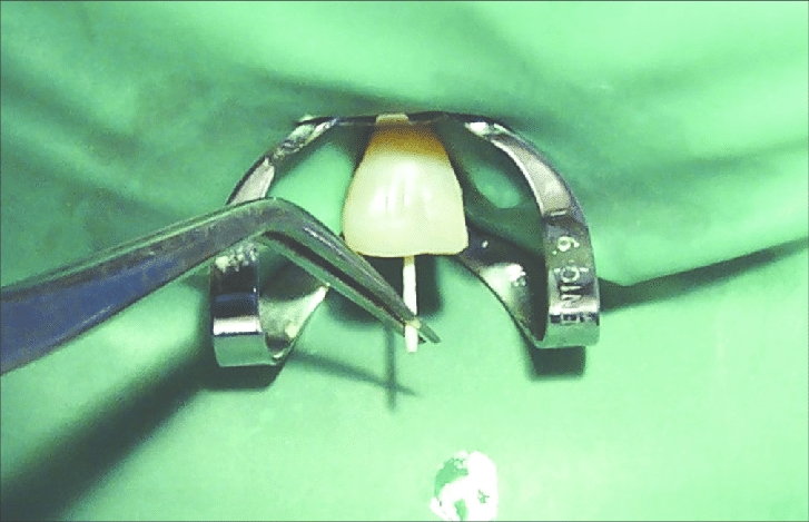 Diadent Gutta Percha Non Standardized - Fine