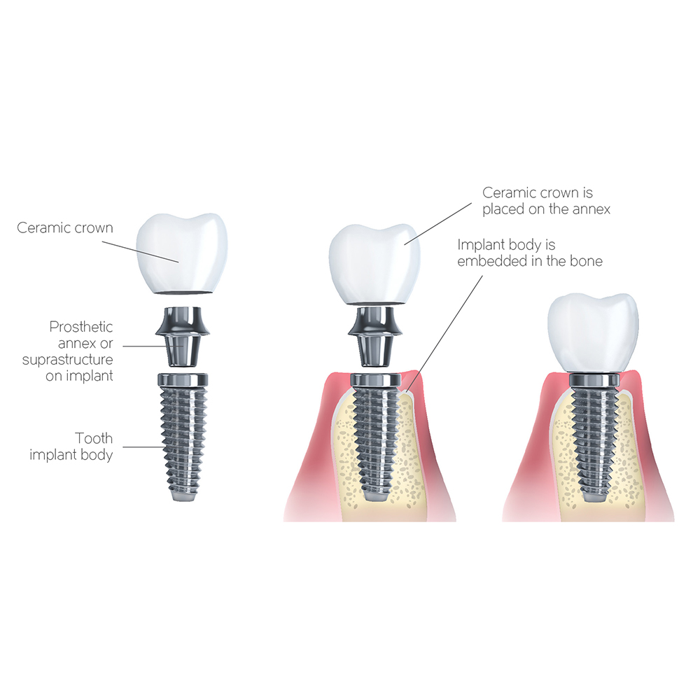 Xcem XE Submerged Dental Implant 4.5mm