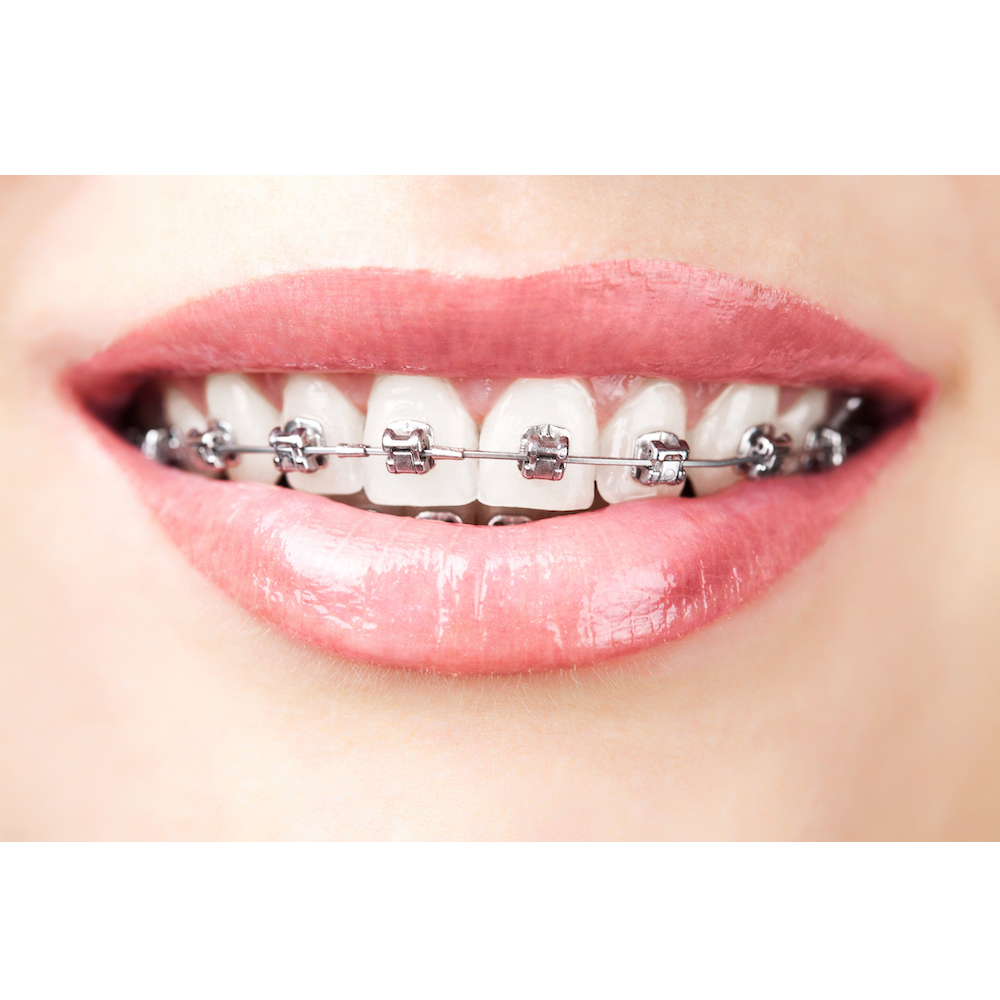 Koden Superelastic NiTi Archwires - Round (Pack of 10)